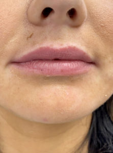 Lip Fillers Before and After Pictures Buffalo, NY