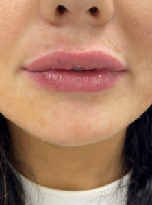 Lip Fillers Before and After Pictures Buffalo, NY