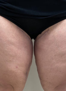Thigh Lift Before and After Pictures Buffalo, NY