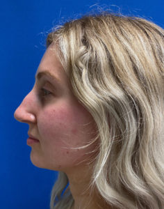 Liquid Rhinoplasty Before and After Pictures Buffalo, NY
