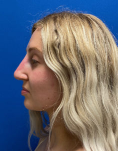 Liquid Rhinoplasty Before and After Pictures Buffalo, NY
