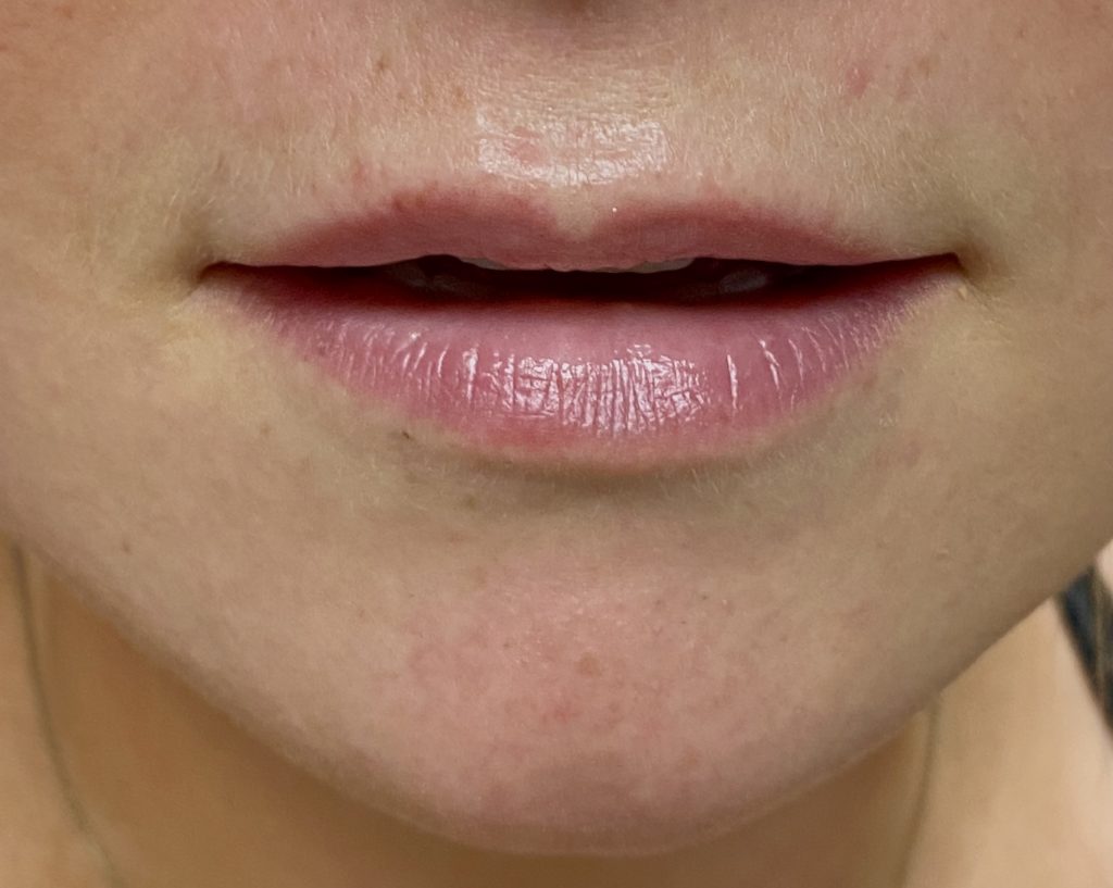 Lip Fillers Before and After Pictures Buffalo, NY