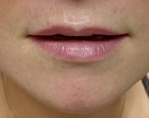 Lip Fillers Before and After Pictures Buffalo, NY