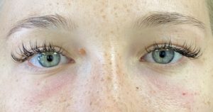 Tear Trough Fillers Before and After Pictures Buffalo, NY