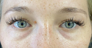 Tear Trough Fillers Before and After Pictures Buffalo, NY