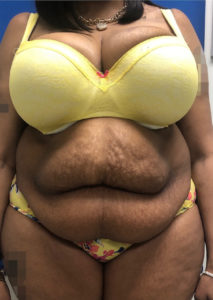 Abdominoplasty (Tummy Tuck) Before and After Pictures Buffalo, NY
