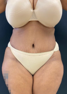 Abdominoplasty (Tummy Tuck) Before and After Pictures Buffalo, NY