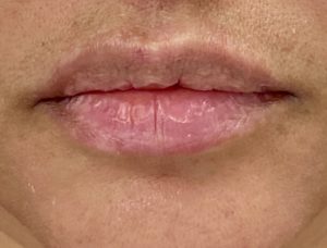 Lip Fillers Before and After Pictures Buffalo, NY