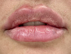 Lip Fillers Before and After Pictures Buffalo, NY