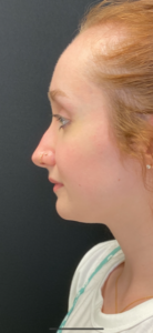 Liquid Rhinoplasty Before and After Pictures Buffalo, NY