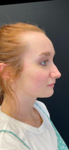 Liquid Rhinoplasty Before and After Pictures Buffalo, NY