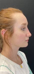 Liquid Rhinoplasty Before and After Pictures Buffalo, NY