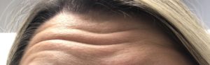 Botox & Dysport Before and After Pictures Buffalo, NY