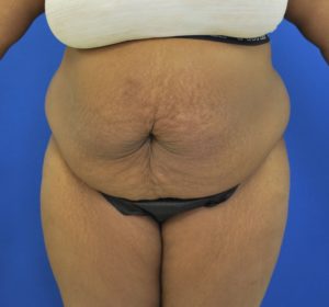 Abdominoplasty (Tummy Tuck) Before and After Pictures Buffalo, NY