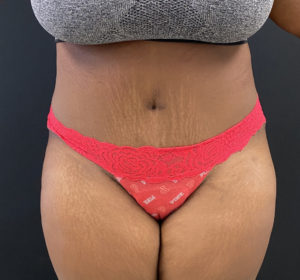 Abdominoplasty (Tummy Tuck) Before and After Pictures Buffalo, NY