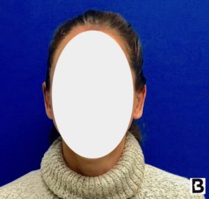 Otoplasty Before and After Pictures Buffalo, NY