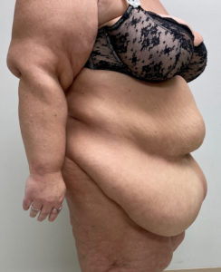 Abdominoplasty (Tummy Tuck) Before and After Pictures Buffalo, NY