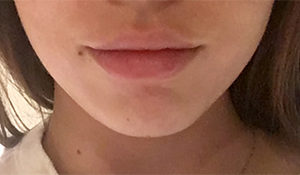Fillers Before and After Pictures Buffalo, NY