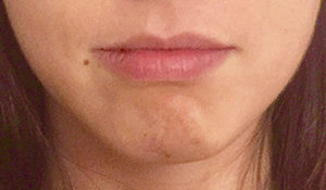 Fillers Before and After Pictures Buffalo, NY