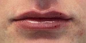 Lip Augmentation Before and After Pictures Buffalo, NY