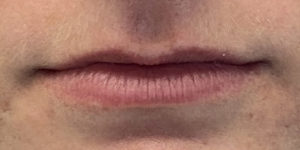 Lip Augmentation Before and After Pictures Buffalo, NY