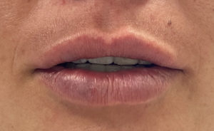 Lip Augmentation Before and After Pictures Buffalo, NY