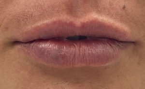 Lip Augmentation Before and After Pictures Buffalo, NY