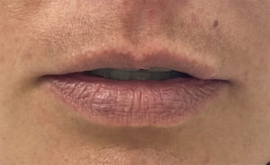 Lip Augmentation Before and After Pictures Buffalo, NY