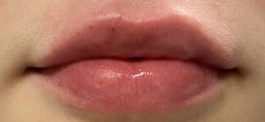 Lip Augmentation Before and After Pictures Buffalo, NY