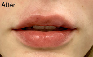 Lip Augmentation Before and After Pictures Buffalo, NY