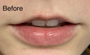 Lip Augmentation Before and After Pictures Buffalo, NY