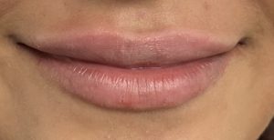 Lip Fillers Before and After Pictures Buffalo, NY