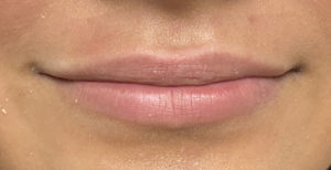 Lip Fillers Before and After Pictures Buffalo, NY