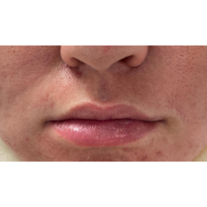 Lip Fillers Before and After Pictures Buffalo, NY