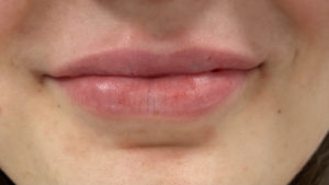 Lip Fillers Before and After Pictures Buffalo, NY