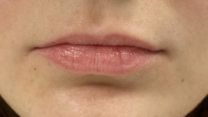 Lip Fillers Before and After Pictures Buffalo, NY