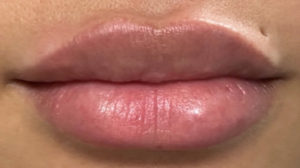 Lip Fillers Before and After Pictures Buffalo, NY