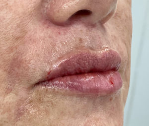 Lip Fillers Before and After Pictures in Buffalo, NY