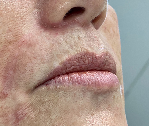Lip Fillers Before and After Pictures in Buffalo, NY