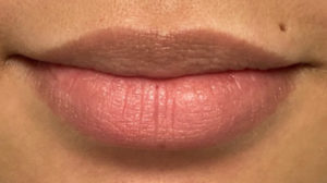 Lip Fillers Before and After Pictures Buffalo, NY