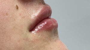 Lip Fillers Before and After Pictures Buffalo, NY