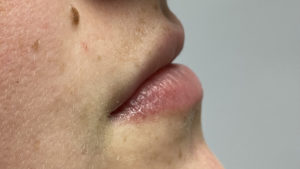 Lip Fillers Before and After Pictures Buffalo, NY