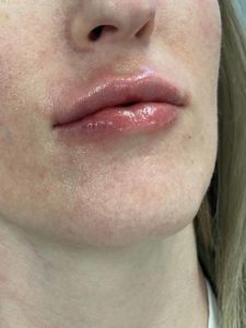 Lip Fillers Before and After Pictures Buffalo, NY