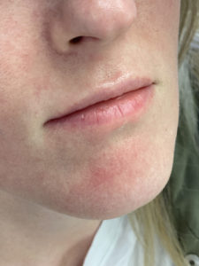 Lip Fillers Before and After Pictures Buffalo, NY