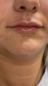Lip Fillers Before and After Pictures Buffalo, NY