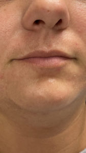Lip Fillers Before and After Pictures Buffalo, NY