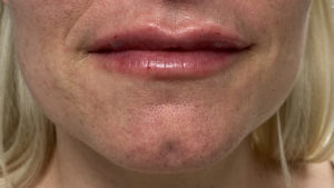 Lip Fillers Before and After Pictures Buffalo, NY