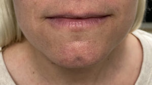 Lip Fillers Before and After Pictures Buffalo, NY