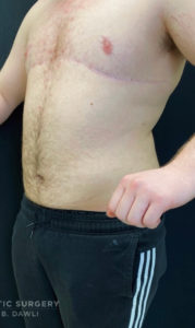 Liposuction Before and After Pictures in Buffalo, NY