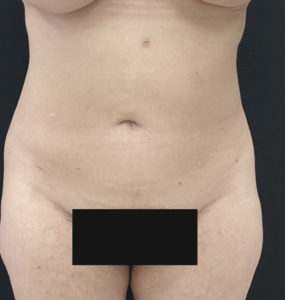 Liposuction Before and After Pictures in Buffalo, NY